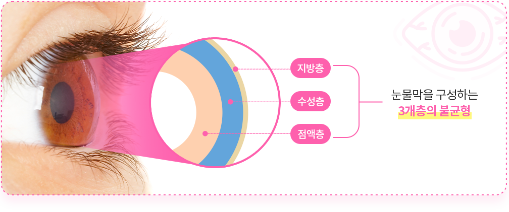 안구건조증은 눈물막을 구성하는 3개층인 지방층, 수성층, 점액층의 불균형으로 발생한다.