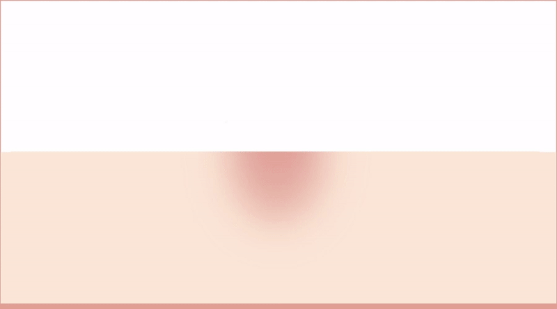 노스카나 흉터 치료 이미지