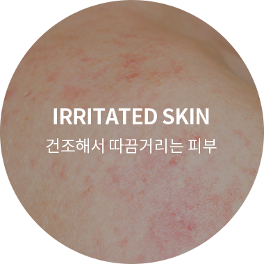 건조해서 따끔거리는 피부